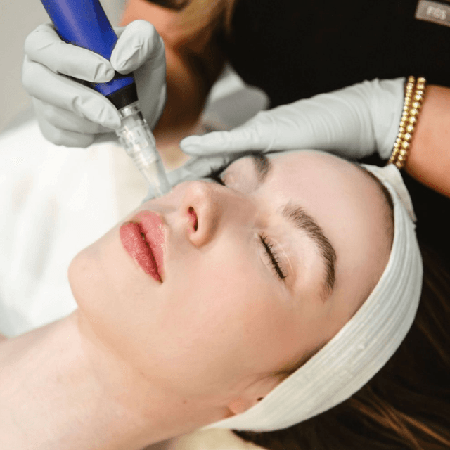 Microneedling with PINK GLOW at LM BEAUTY AESTHETICS in Everett, MA
